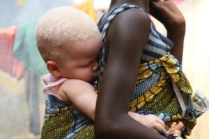 bambino albino