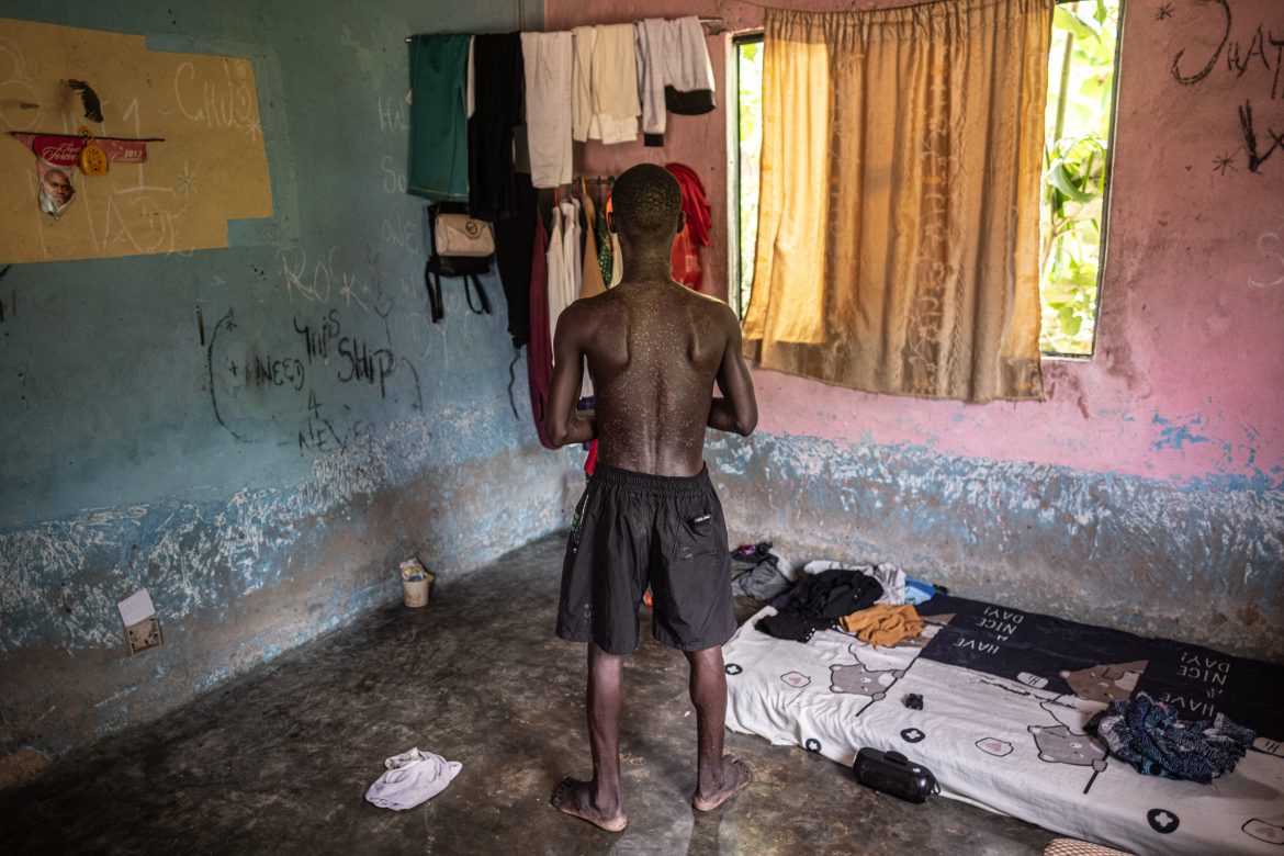 Un giovane della comunità di Ikarama soffre di una malattia della pelle, probabilmente causata dal contatto con le acque contaminate della zona. Bayelsa State, Nigéria. Foto di Marco Simoncelli / IrpiMedia.